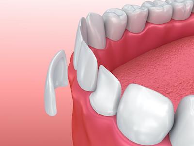 close up of veneer in jaw | dentist vienna va