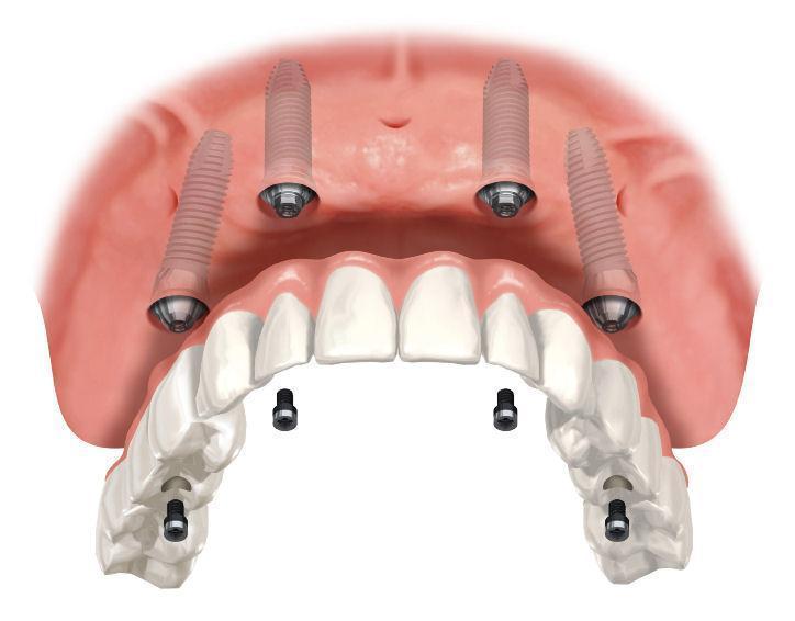 Dental Implants | Tysons Dentist