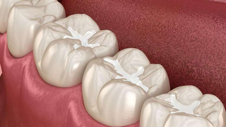dental sealant in vienna va