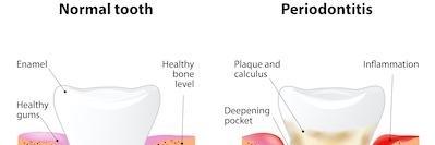 image of regular tooth and an infected tooth in vienna va