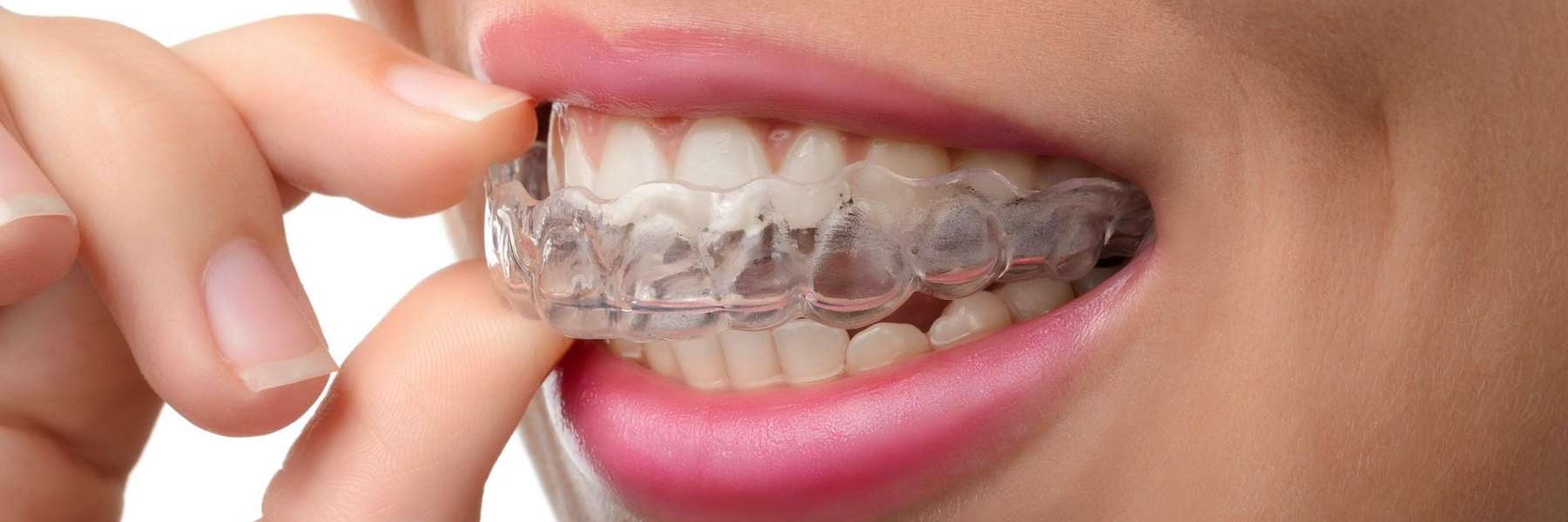 Woman with clear braces, showcasing Invisalign as a discreet orthodontic solution.