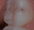 a molar in need of a filling | dental fillings vienna