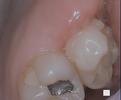 gums that have had growth removed | dentist in vienna va