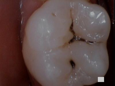 a tooth with deep grooves | dental fillings vienna va