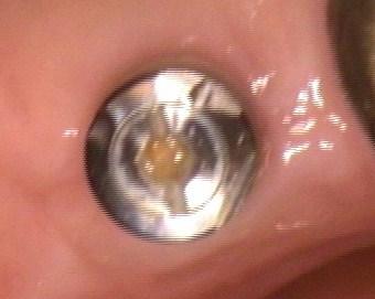a dental implant without a crown | dental implants vienna va