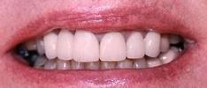 new crown and bridges show no gap between tooth and gum line | crowns and bridges in vienna va
