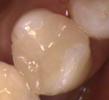 a tooth that has had a broken silver filling removed and replaced with a porcelain on-lay | dentist in vienna va
