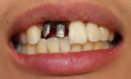 a patient's mouth with implant posts, but no teeth | dental implants vienna va