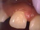 A piece of gum that has a lesion on it | laser dentistry vienna va