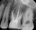 Root-Canal-Treatment-After-Image