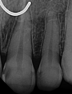 an x-ray image before a root canal procedure | root canal dentist in vienna