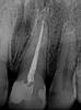 Root-Canal-Treatment-After-Image