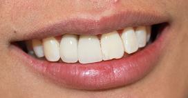 a patients mouth who's had crowns placed on his implant posts | vienna va dental implants