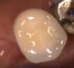a new crown sitting atop a dental implant | dental implants vienna va