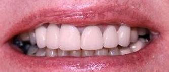 new crown and bridges show no gap between tooth and gum line | crowns and bridges in vienna va