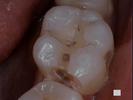 Tooth-Colored-Composite-Filling-Before-Image
