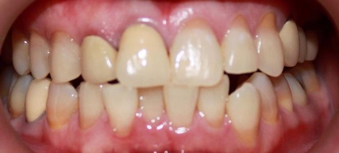 a smile before an invisalign treatment from our vienna va office