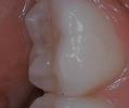 a tooth that has had a composite resin filling | dentist in vienna
