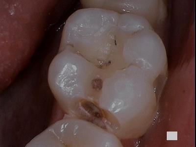 a decayed molar | dentist in vienna va
