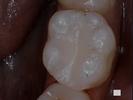 Tooth-Colored-Composite-Filling-After-Image