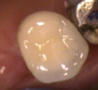 a new crown sitting atop a dental implant | dental implants vienna va