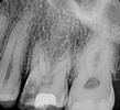 Root-Canal-Treatment-Before-Image