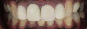 a patient with different sized dental crowns | dental crowns in vienna VA