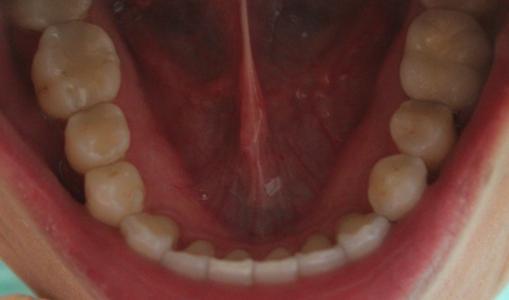 a top down view of a patients lower teeth after receiving invisalign | invisalign dentist vienna va