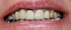 a patient with old crowns and bridge that had gaps between the gumline and the teeth | crowns and bridges vienna va