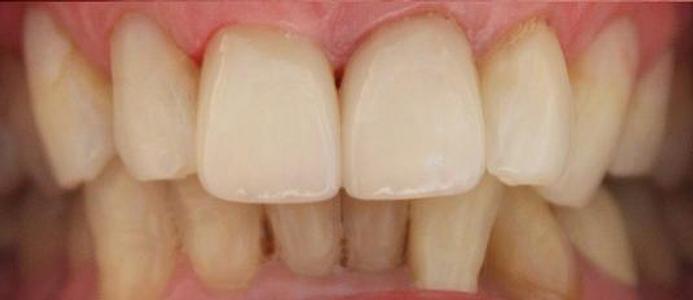 a smile after teeth whitening | vienna va teeth whitening