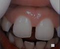patients mouth after a gum lesion has been removed | laser dentist vienna va