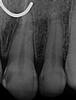 Root-Canal-Treatment-Before-Image