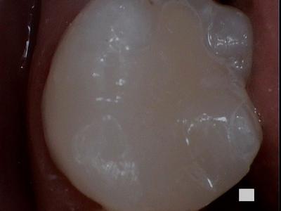 a tooth who's grooves have been filled with resin | dental fillings vienna