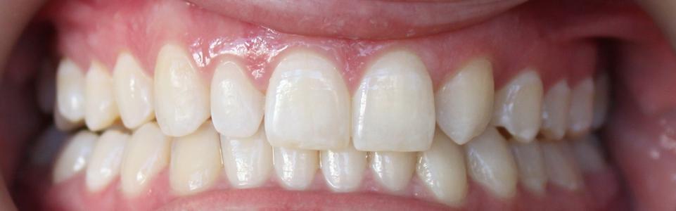 a smile without gaps | invisalign vienna va