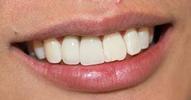 a patients mouth who's had crowns placed on his implant posts | vienna va dental implants