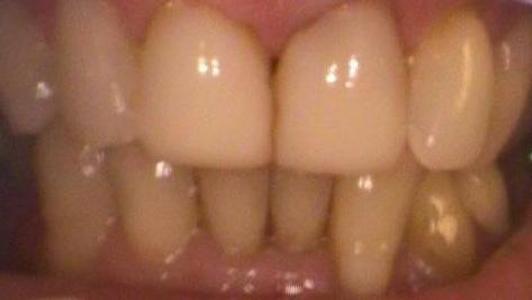a smile before zoom whitening | vienna va teeth whitening