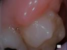 gum with a growth | laser dentistry vienna va