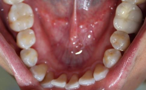 a top-down view of a patients mouth before recieving an invisalign treatment | invisalign dentist vienna va