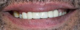 a smile that has had old gold crowns replaced with tooth colored crowns | dental crowns vienna