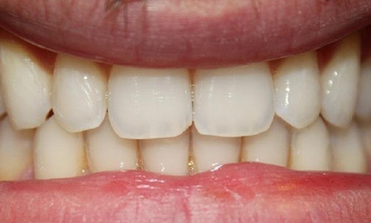 two front teeth with no gap, and less gum tissue in between | invisalign vienna va