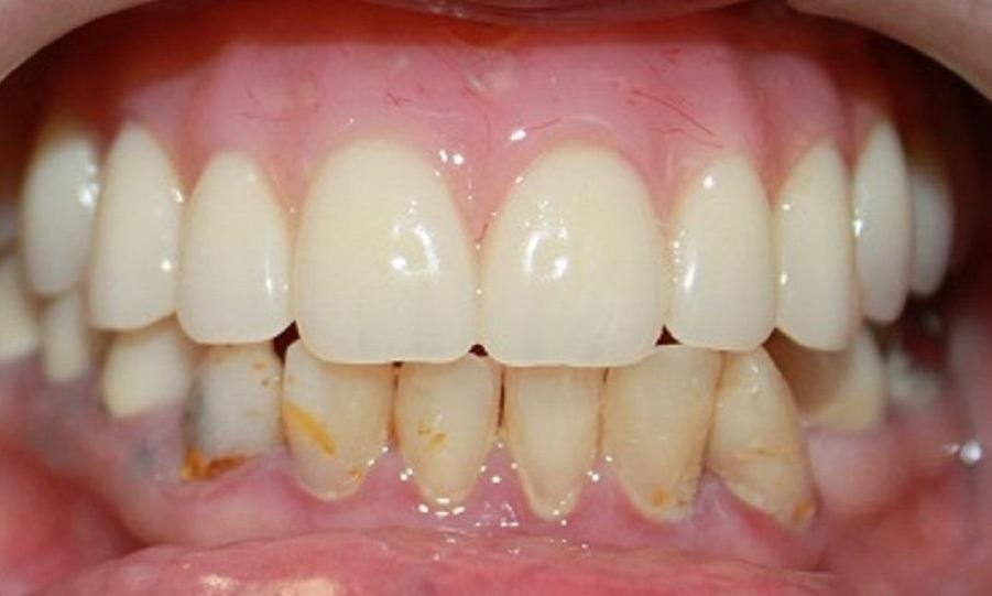 a new top denture, crafted from our vienna, va dental office