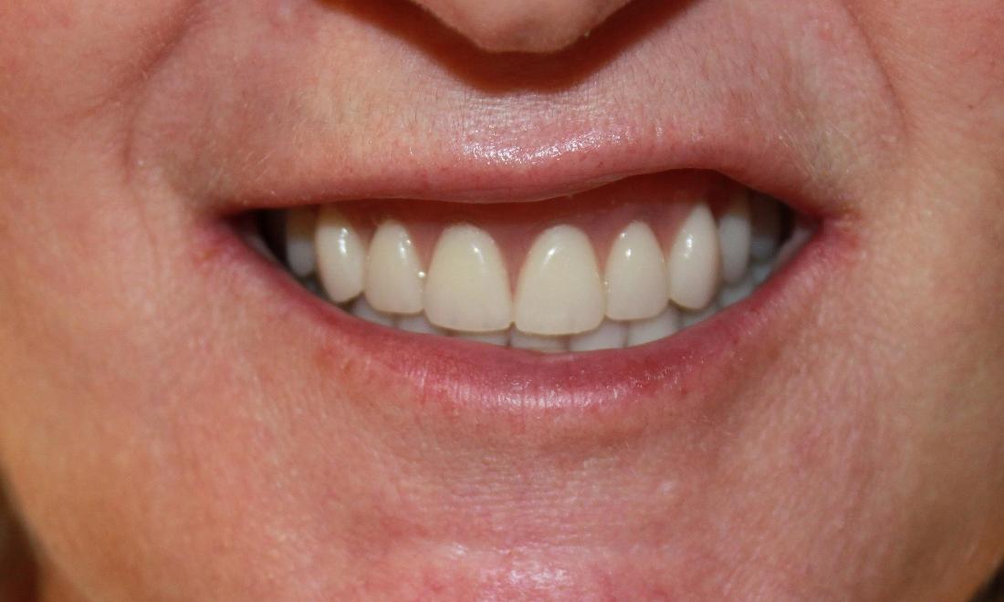 a smile with a full set of teeth, thanks to dentures crafted from our vienna va office