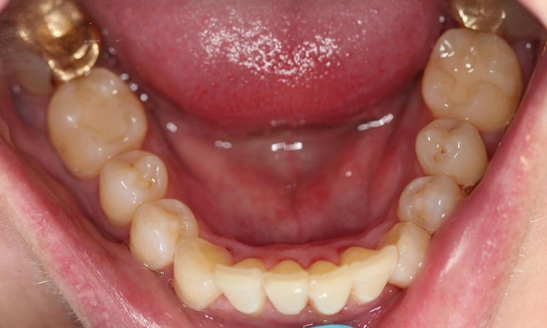 teeth after an invisalign treatment | vienna va invisalign