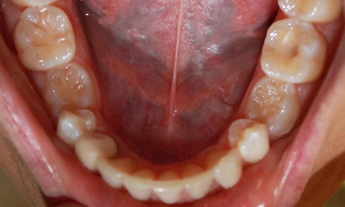 lower front teeth after invisalign | dentist in vienna va
