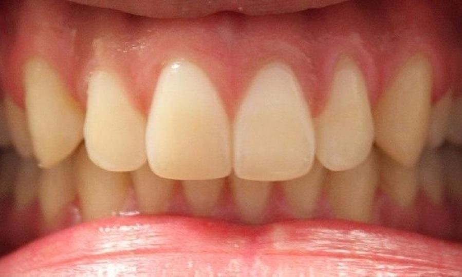 upper front teeth after invisalign treatment, without gap | invisalign dentist in vienna virginia