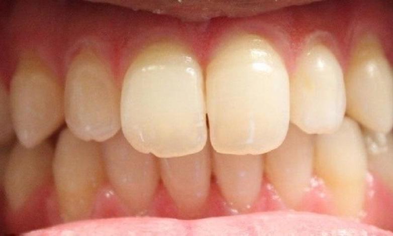 a patients upper front teeth, now aligned together after an invisalign treatment | invisalign dentist in vienna