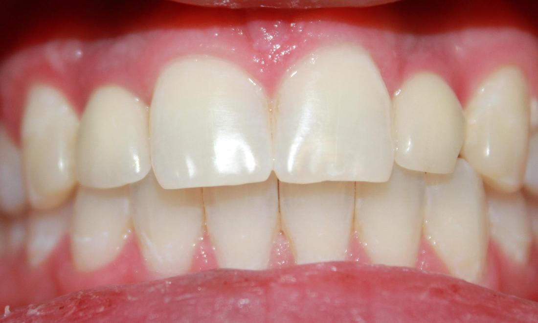 teeth after a laser whitening treatment | teeth whitening dentist in vienna