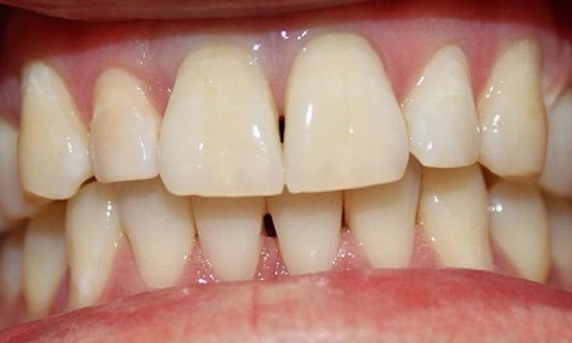 teeth after a laser whitening procedure at our vienna office | laser teeth whitening vienna