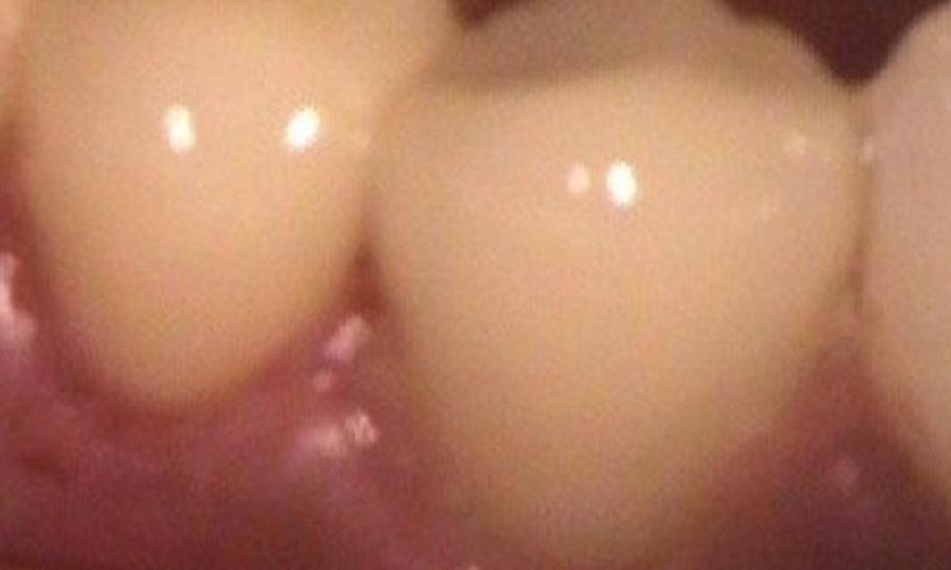 porcelain crown | vienna va | tysons dentistry 
