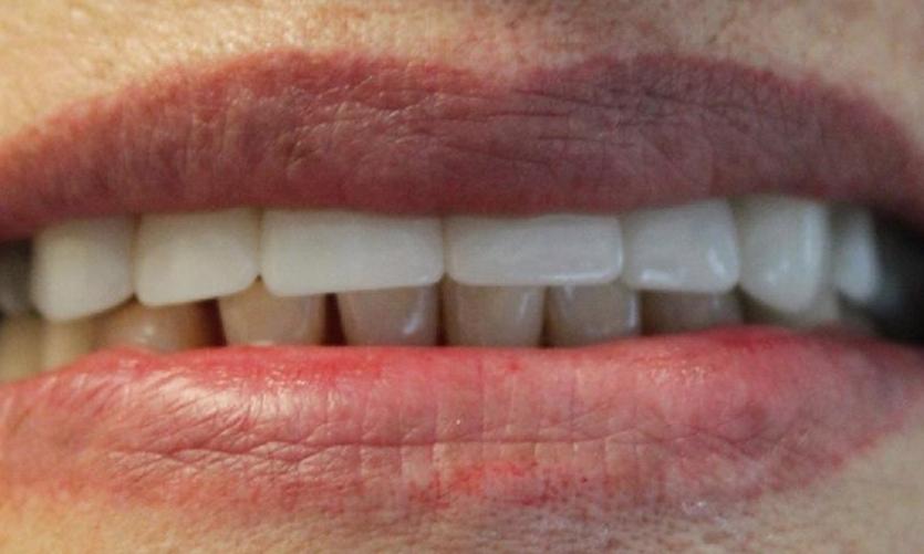 a set of teeth after dental crowns | dental crowns in vienna